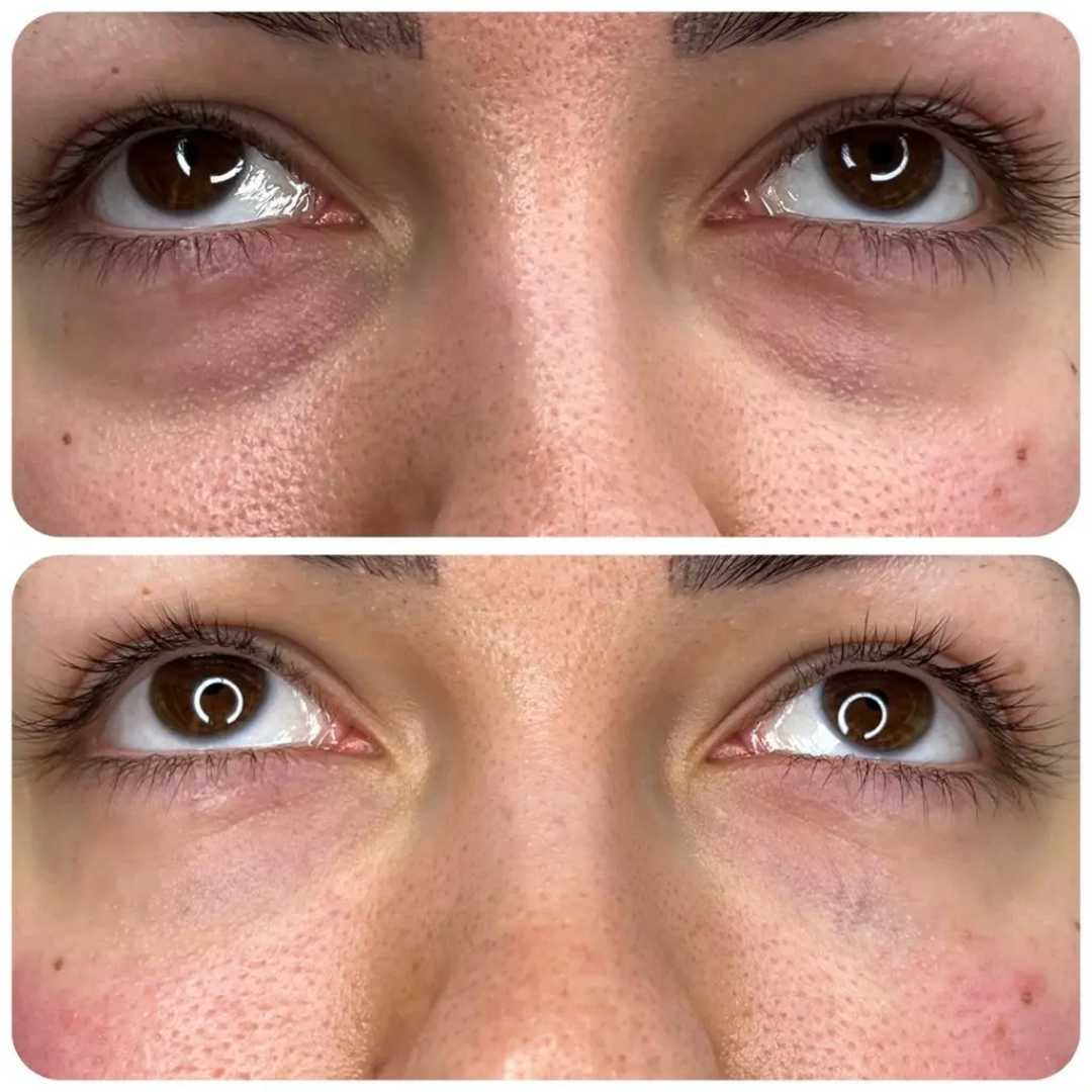 Naturalize Hyaluron Eye Roll-On – Anti-Puffiness & Dark Circles – Brighter, Smoother & Younger Eyes – With Hyaluronic Acid & Cooling Metal Roller – Reduces Dark Circles, Puffiness & Fine Lines