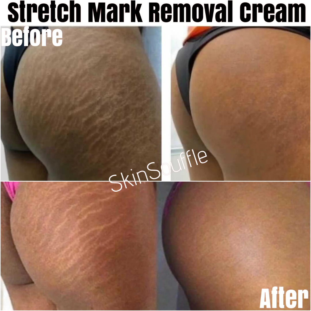 Ciara Stretchmarks Treatment Oil – Fade Stretchmarks on Belly & Thighs – With Fish Collagen – Nourish, Repair & Renew – Deeply Hydrates, Improves Elasticity – Safe for Sensitive Skin