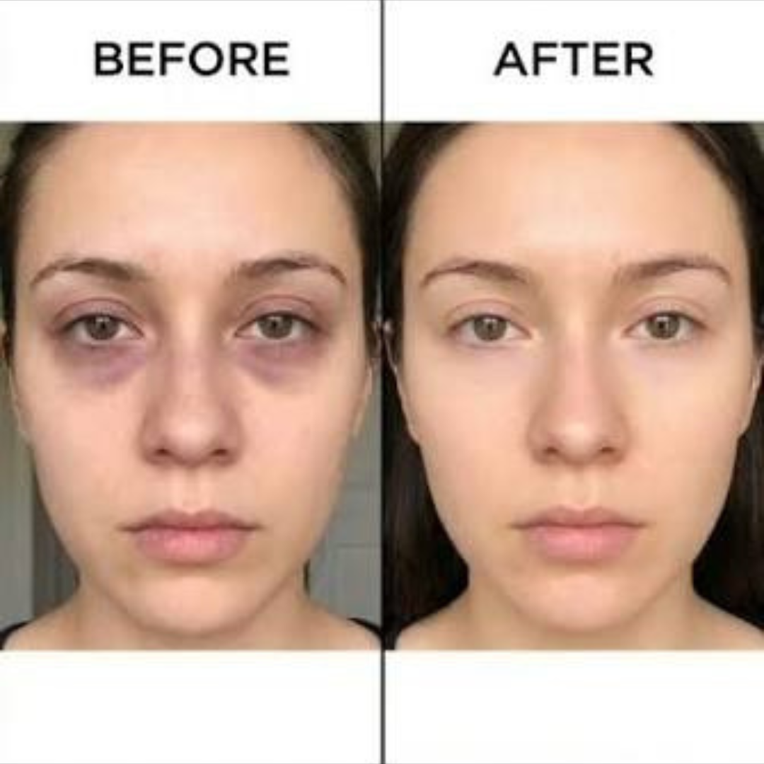 Naturalize Hyaluron Eye Roll-On – Anti-Puffiness & Dark Circles – Brighter, Smoother & Younger Eyes – With Hyaluronic Acid & Cooling Metal Roller – Reduces Dark Circles, Puffiness & Fine Lines