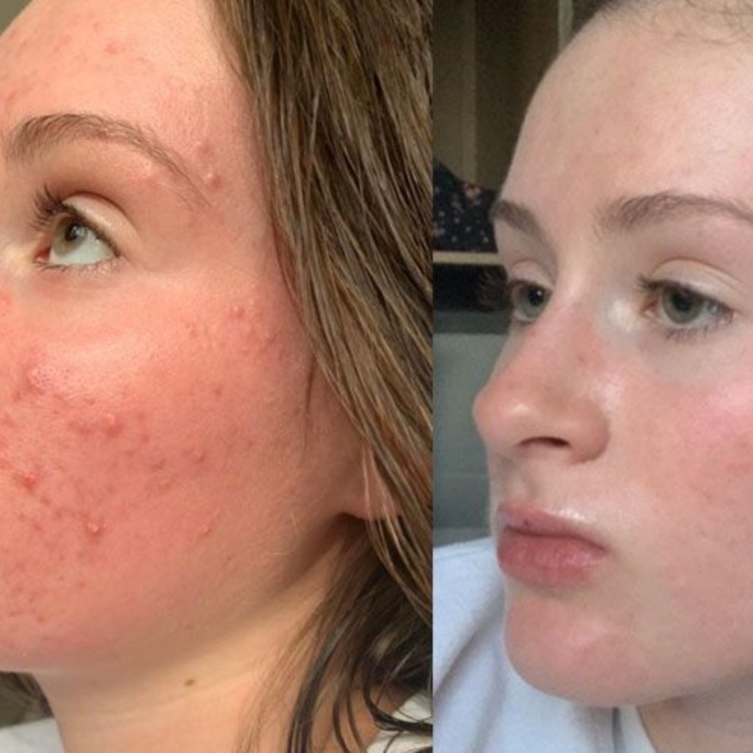 Axis-y Pore Clarifying & Acne treatment Mask | Gently clean pores & remove ance | bright & clean skin