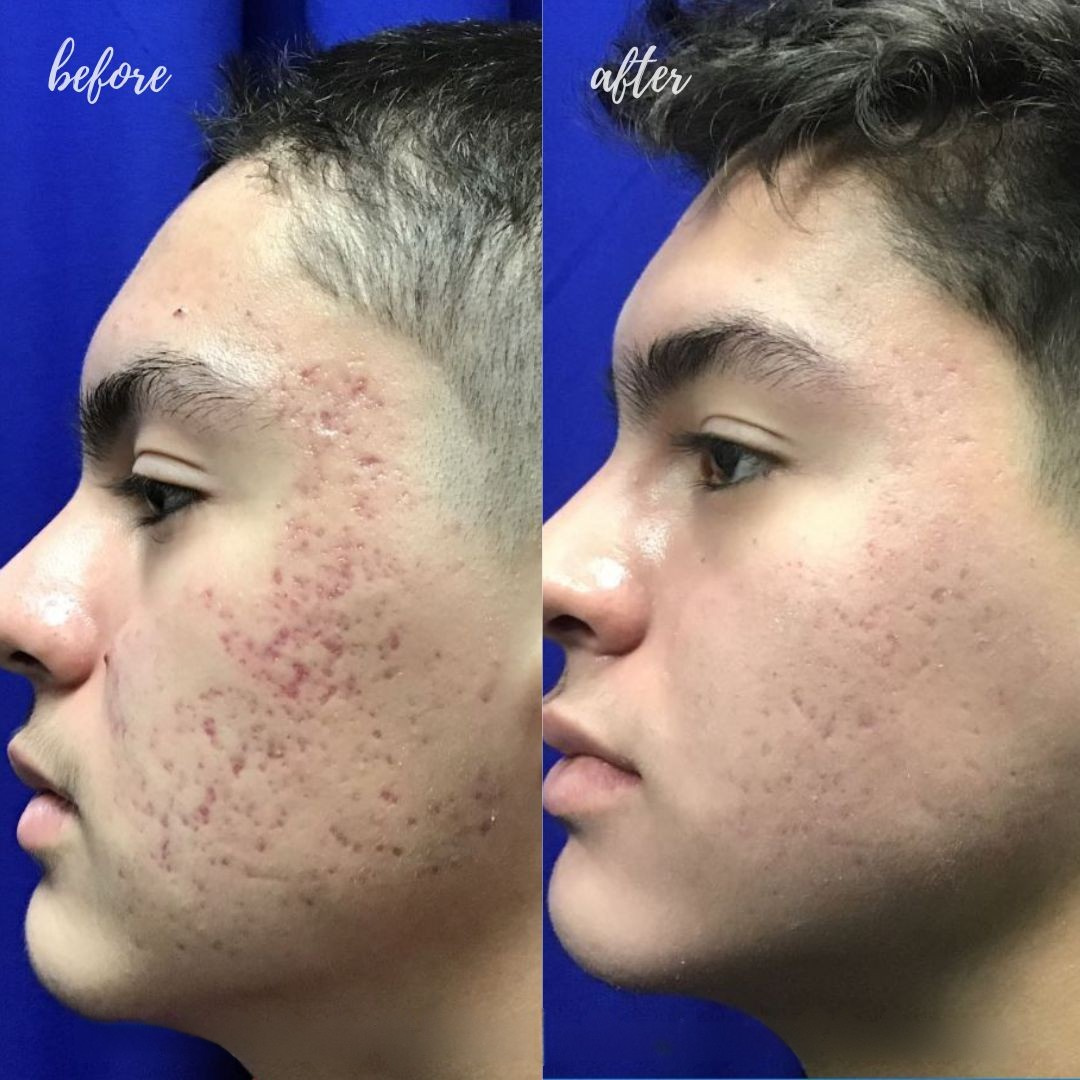 Ivoskin Intensive Cica Repair Cream | 85% Naturally Derived with Madecassoside, Ceramides & Hyaluronic Acid | Calms Redness, Clears Acne & Repairs Skin Barrier