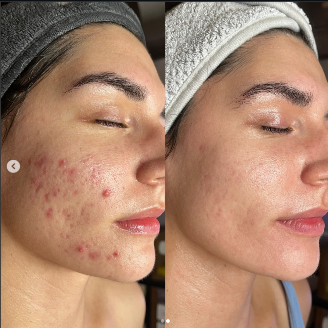 Ivoskin Intensive Cica Repair Cream | 85% Naturally Derived with Madecassoside, Ceramides & Hyaluronic Acid | Calms Redness, Clears Acne & Repairs Skin Barrier