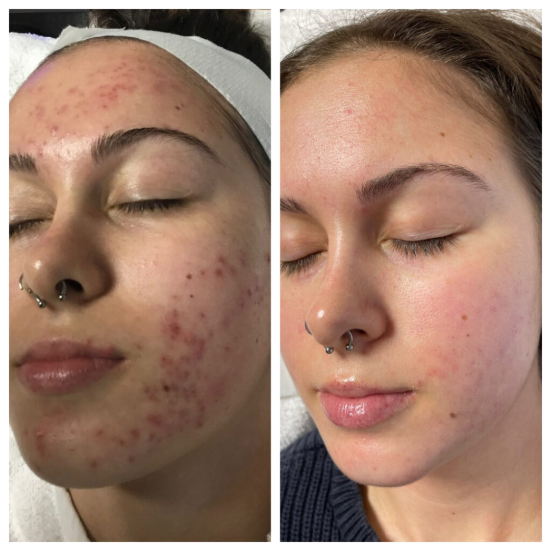 Ivoskin Intensive Cica Repair Cream | 85% Naturally Derived with Madecassoside, Ceramides & Hyaluronic Acid | Calms Redness, Clears Acne & Repairs Skin Barrier