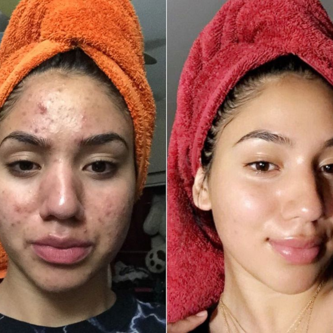 Ivoskin Intensive Cica Repair Cream | 85% Naturally Derived with Madecassoside, Ceramides & Hyaluronic Acid | Calms Redness, Clears Acne & Repairs Skin Barrier