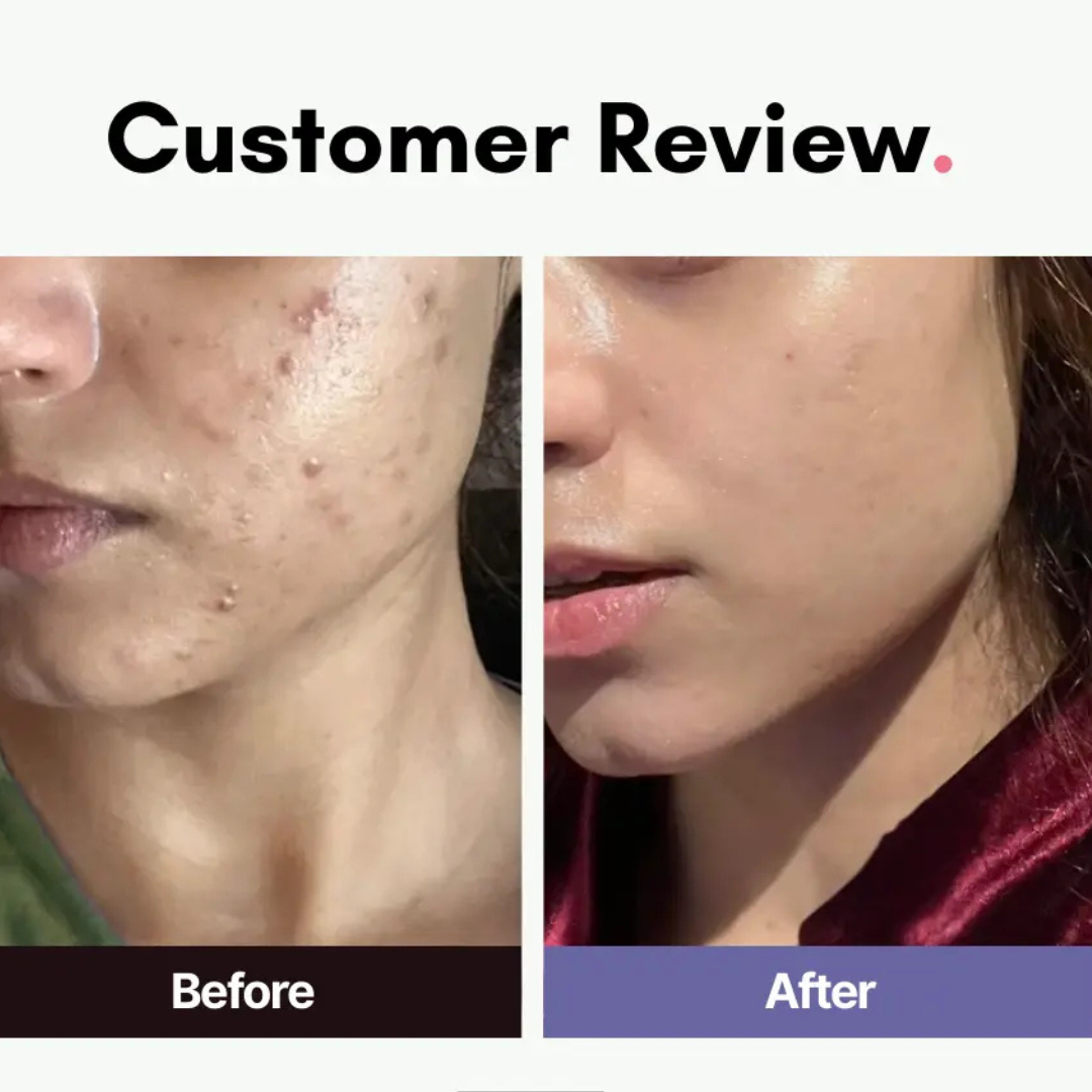 Ivoskin Intensive Cica Repair Cream | 85% Naturally Derived with Madecassoside, Ceramides & Hyaluronic Acid | Calms Redness, Clears Acne & Repairs Skin Barrier