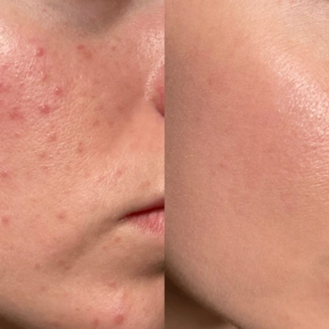 KINUI Calm-7 Soothing Serum | 7 Skin-Perfecting Ingredients with 3 Types of CICA, PDRN, Niacinamide, Panthenol & Tea Tree | Pore Control, Oil Balance & Pigmentation Care