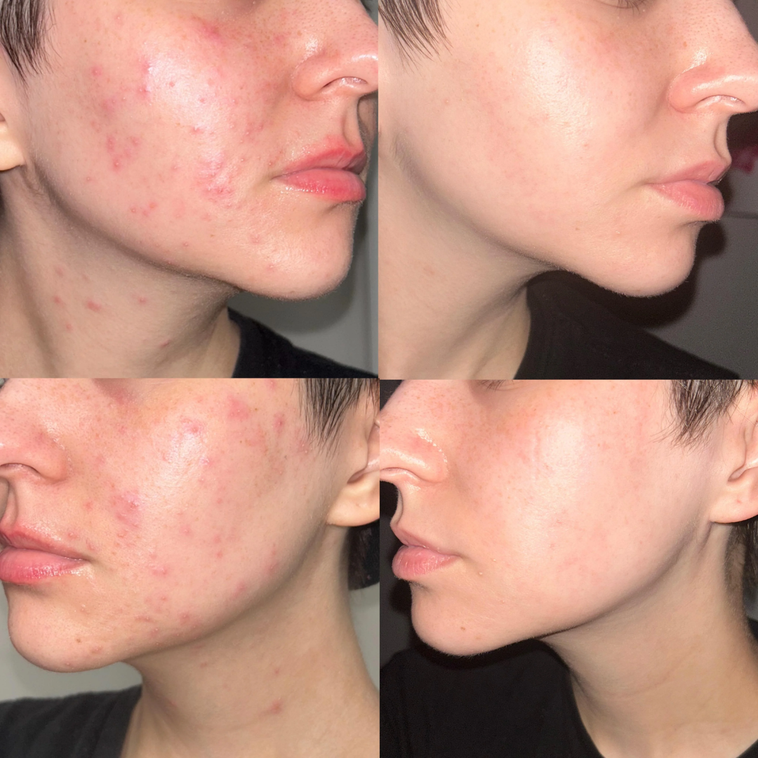 KINUI Calm-7 Soothing Serum | 7 Skin-Perfecting Ingredients with 3 Types of CICA, PDRN, Niacinamide, Panthenol & Tea Tree | Pore Control, Oil Balance & Pigmentation Care