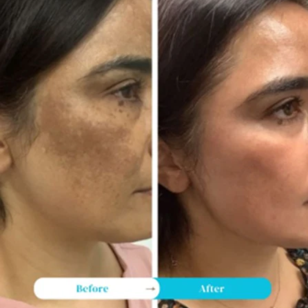 Melaglow Rich Depigmentation & Glow Restoration Cream – Reduces Dark Spots & Pigmentation, Evens Skin Tone, Boosts Natural Glow – Safe & Gentle for Daily Use – For Brighter, Even-Toned Healthy Skin