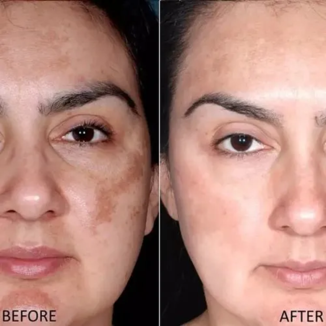 Melaglow Rich Depigmentation & Glow Restoration Cream – Reduces Dark Spots & Pigmentation, Evens Skin Tone, Boosts Natural Glow – Safe & Gentle for Daily Use – For Brighter, Even-Toned Healthy Skin